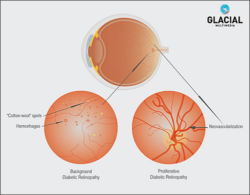 Diabetic Retinopathy