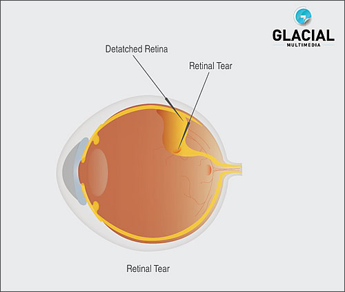 retinal tear